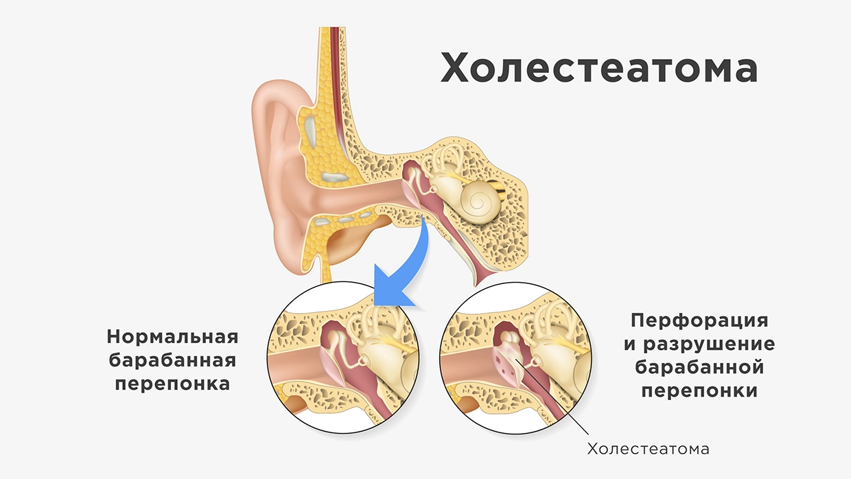 Опухоль под ухом